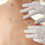 ¿Qué es melanoma ?